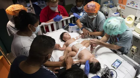 Texas Children&#039;s Hospital announces successful separation of conjoined twin brothers Lucas and Mateo