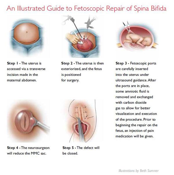 Fetoscopic Repair Spina Bifida