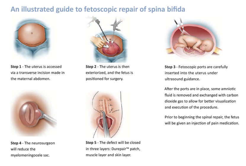 Spina Bifida Repair