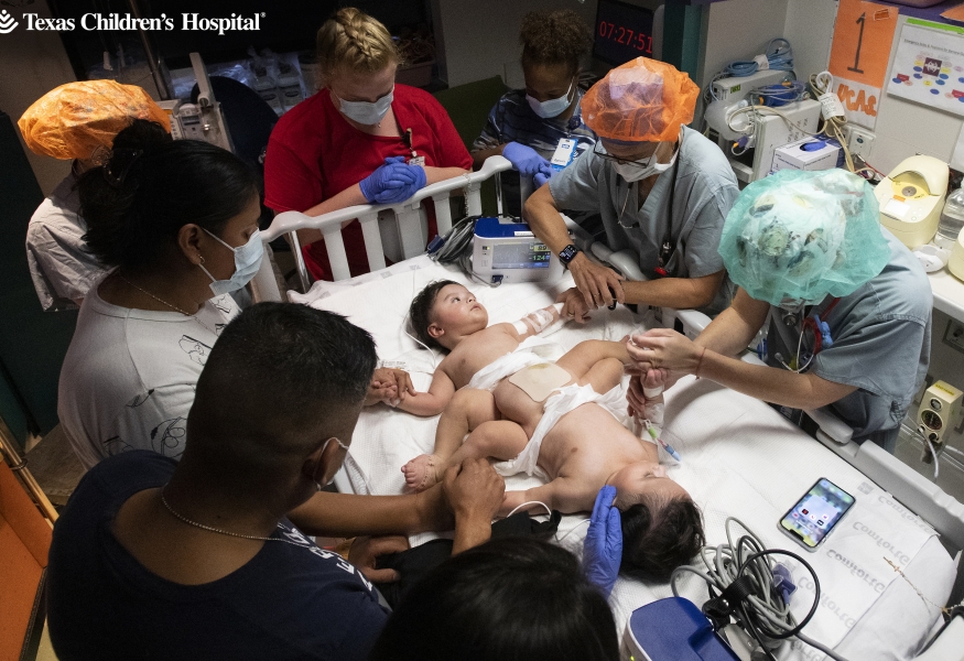 Conjoined twins Lucas and Mateo prior to separation 
