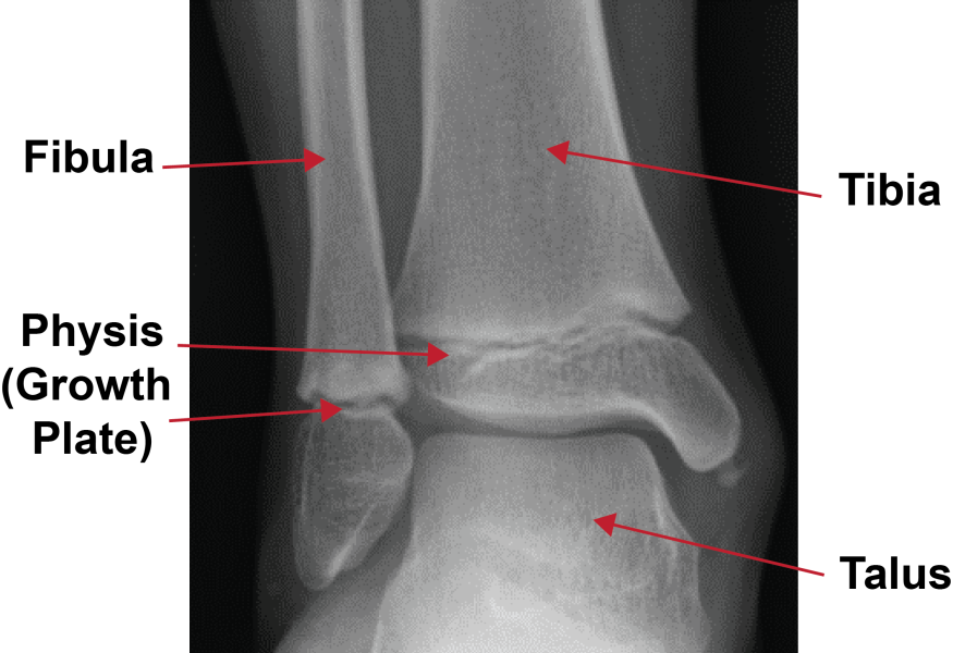 Ankle Fracture  Texas Children's
