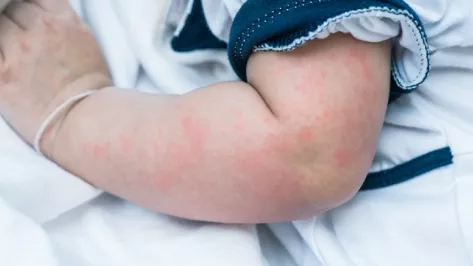Hives on child's arm