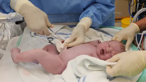 cord clamping