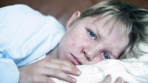 Boy with measles