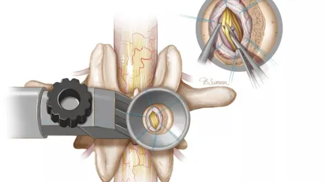 Focal rhizotomy image