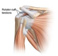 Rotator Cuff Tendonitis