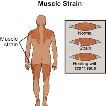 musclestrain