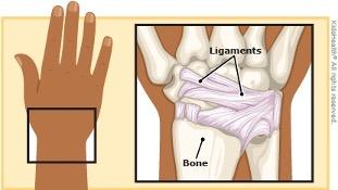 sprained wrist