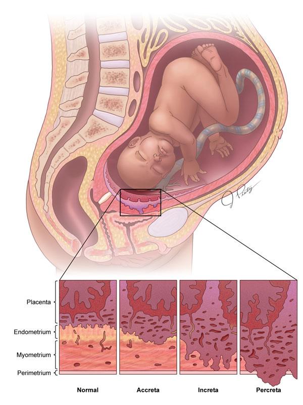 12_Placenta Accreta