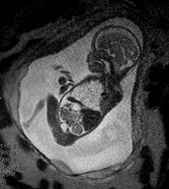 MRI-CPAM