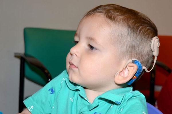 cochlear implant