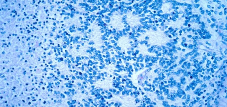 Neuroblastoma