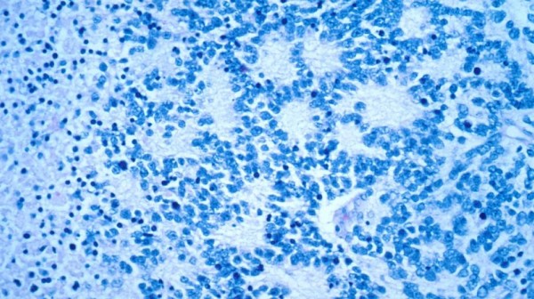 Neuroblastoma