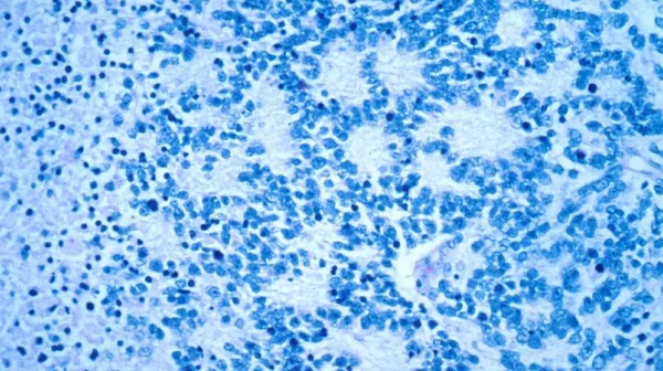 Neuroblastoma