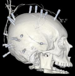 Skull EEG