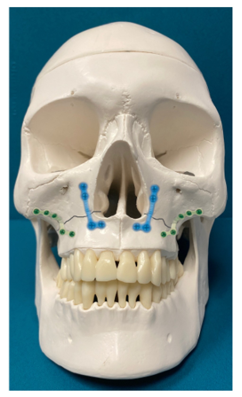 Maxillary fractures