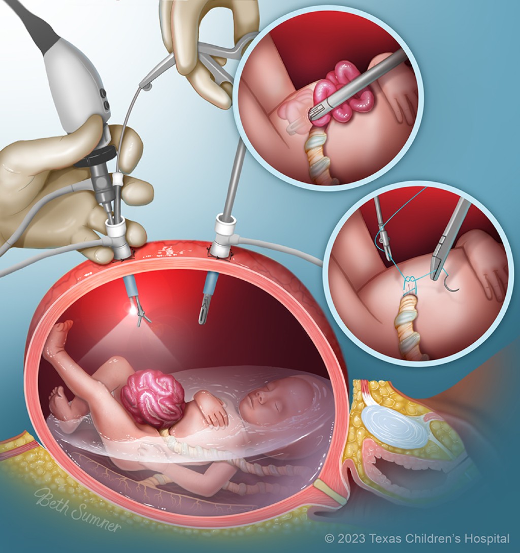 FetalSurgery_gastroschisis
