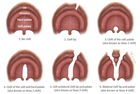 Types of Clefts