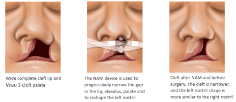 Cleft Types