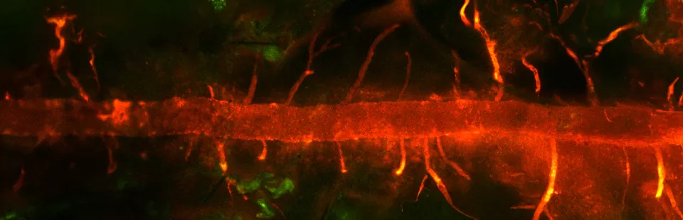 <p>Ependymoma</p>