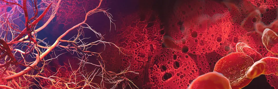 <p>Sickle Cell Disease and Vascular Inflammation</p>