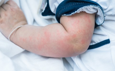 Hives on child's arm