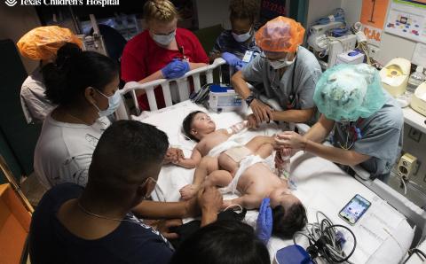Texas Children's Hospital announces successful separation of conjoined twin brothers Lucas and Mateo