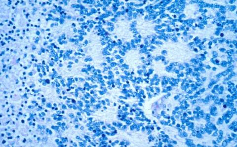 Neuroblastoma