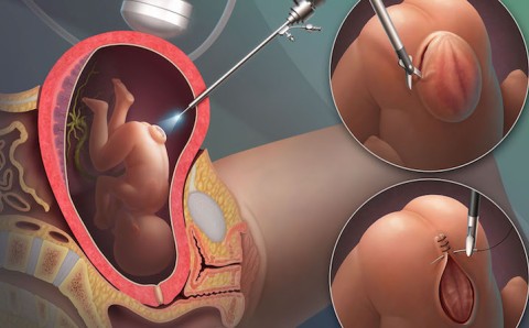Fetoscopic Repair of Spina Bifida
