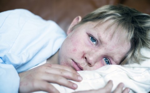 Boy with measles